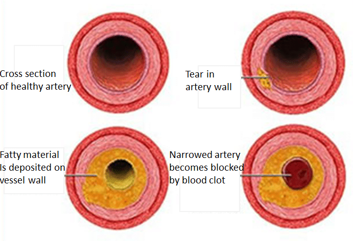 A series of images showing the progressive narrowing of an artery leading to occlusion and potential myocardial infarction.