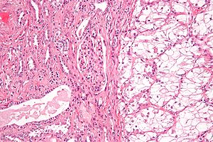 Histoloigcal image of renal cell carcinoma