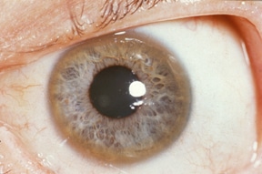Shows a cornea with the classical yellow-brown Keyser-Fleischer rings seen in copper overload