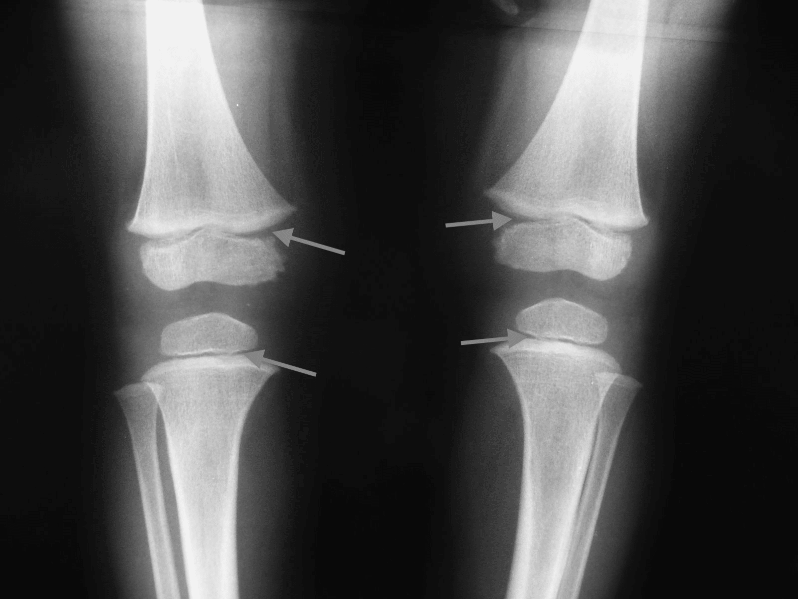 X-ray showing growth plates