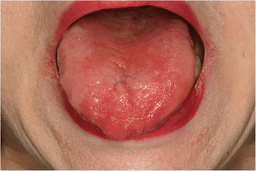 Tongue with central redness and sheen.